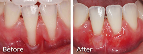 gum surgery
