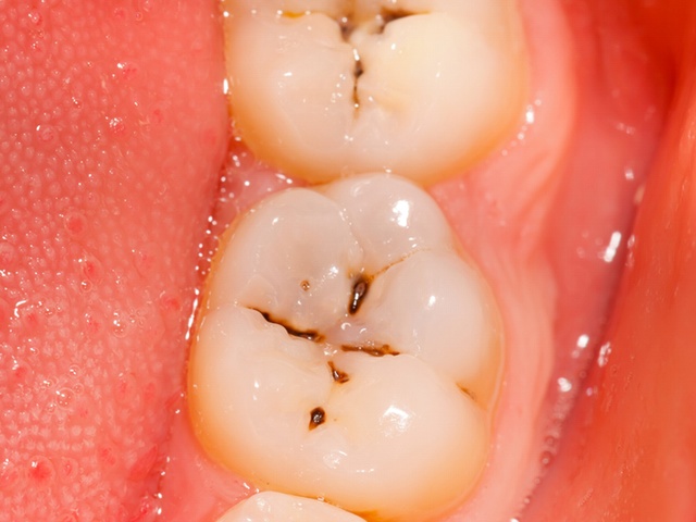 how to easily heal cavities at home
